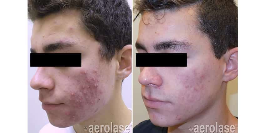 NeoClear Acne After 4 Treatments Kevin Pinski MD
