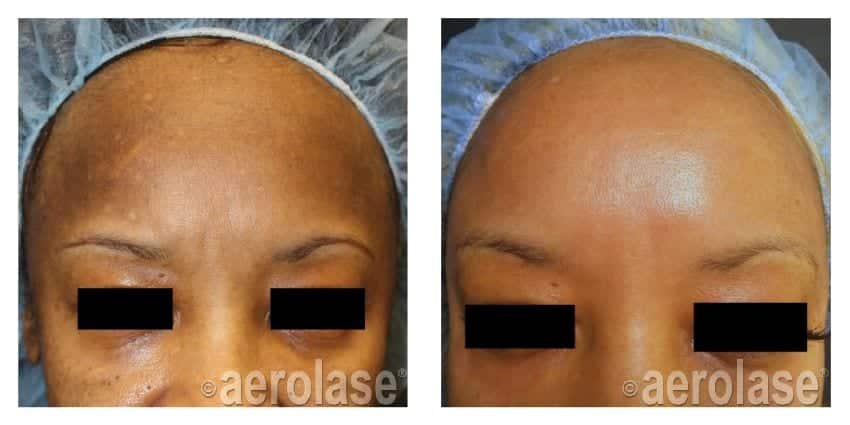 NeoSkin Melasma After 1 Treatment combined with Glycolic Peel Cheryl Burgess MD