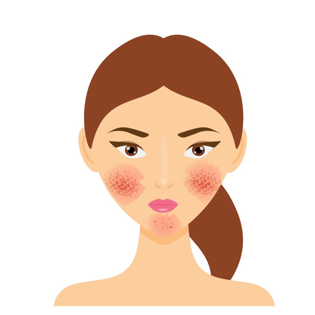 could your acne be rosacea 5fcea6764b927