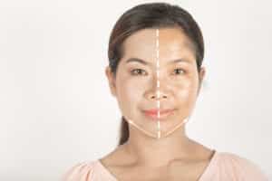 image showing a woman's face with a drawn line down the middle. one half of her face has melasma, the other does not.