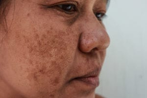 close-up image of a person's face showing melasma