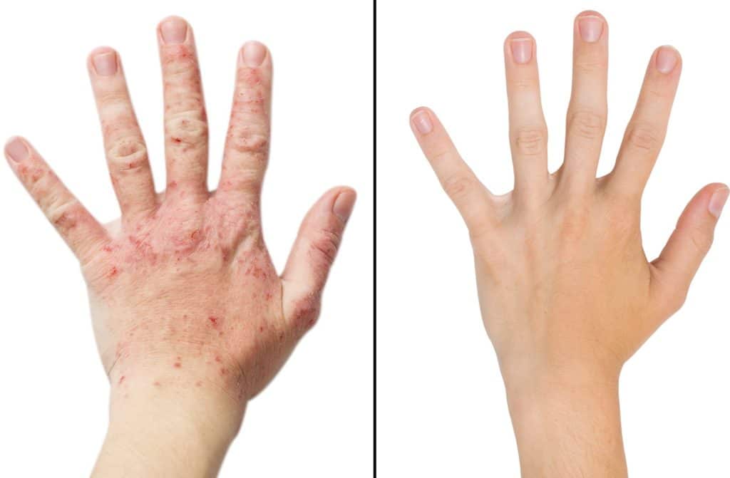 keep your eczema in check this winter 5fcea66d46e11