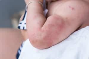 what to do if you have a skin rash 5ff6329f84a14